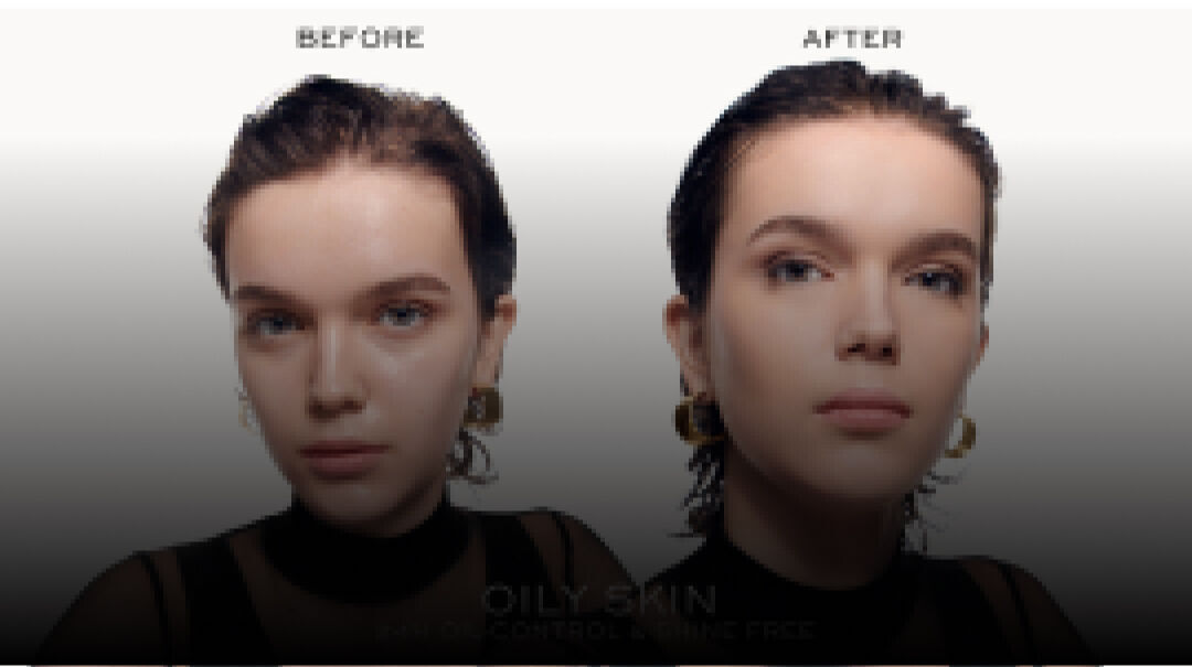 Immagine che mostra un confronto "prima e dopo" di una ragazza, evidenziando i miglioramenti nella pelle grassa.