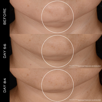 Immagine che mostra il miglioramento della pelle sotto il mento in tre fasi: prima, giorno 56 e giorno 84.